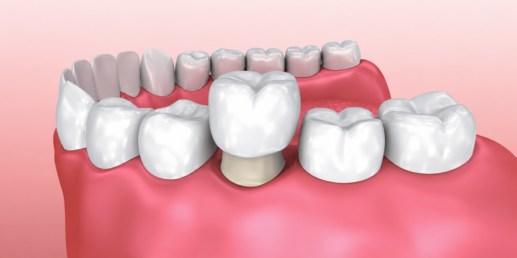 Dental Crowns